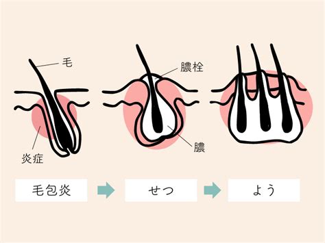 クリトリス ほくろ|これって性病？デリケートゾーンのニキビやしこりの原因と対処。